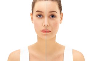 warszawa-mikroiglowa-mezoterapia