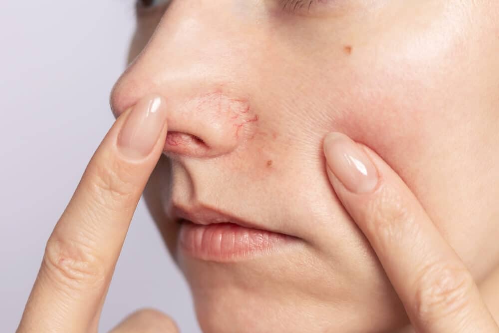 rozszerzone-naczynka-twarz